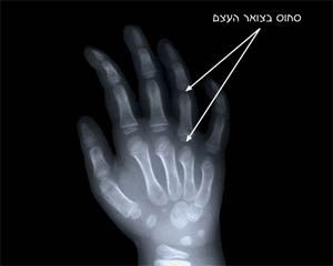 רנטגן של כף יד